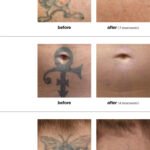 TattooRemoval-before- o efter