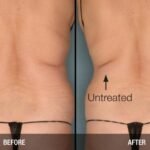 velashape-flank-back-fat-bh linjen