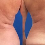 20190903-coolsculpt-vela-bluebackground-lg