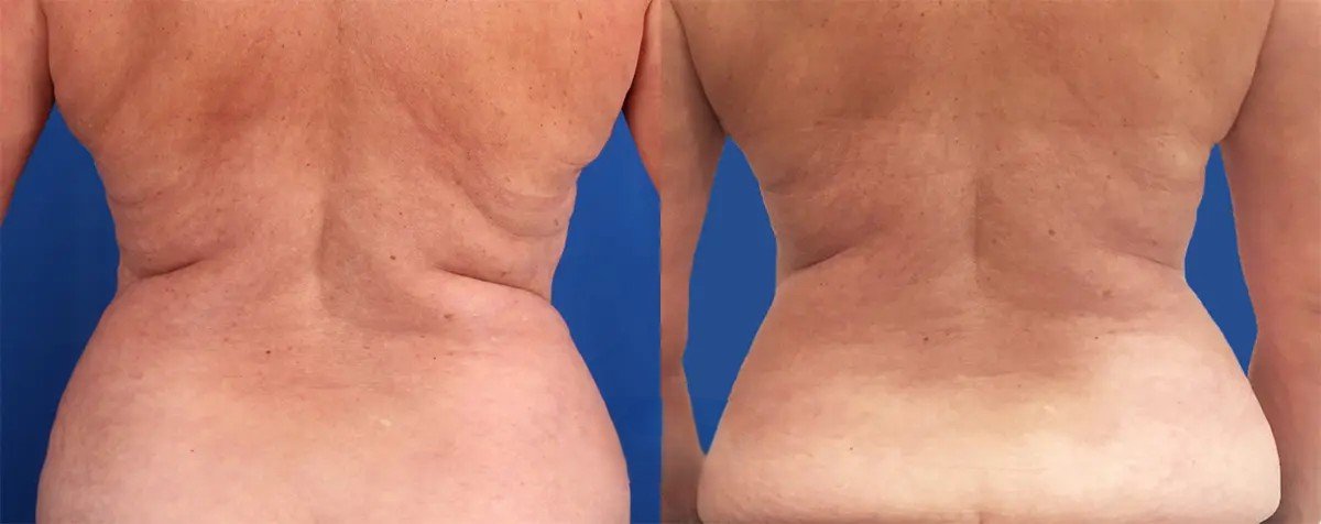 20190903-coolsculpt-vela-bluebackground-lg