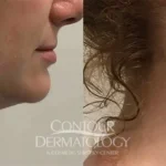 87332-Velashape-Chin.jpg