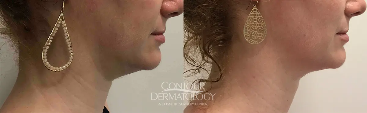 87332-Velashape-Chin.jpg