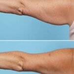 collsculpting-arms-before-and-after-3221-02-710x1030