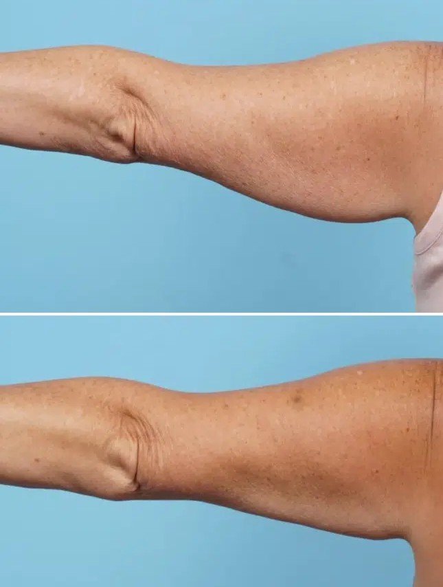 collsculpting-arms-before-and-after-3221-02-710x1030